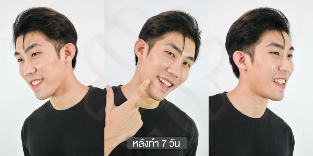 รีวิวเซลล์รักษาฝ้า รักษาฝ้า