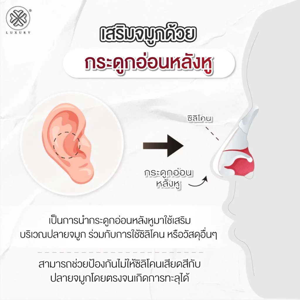 เสริมจมูกด้วยกระดูกอ่อนหลังหู luxury Clinic