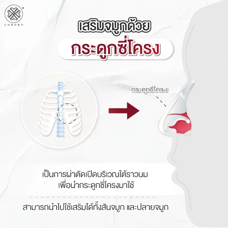 เสริมจมูกด้วยกระดูกซี่โครง luxury Clinic