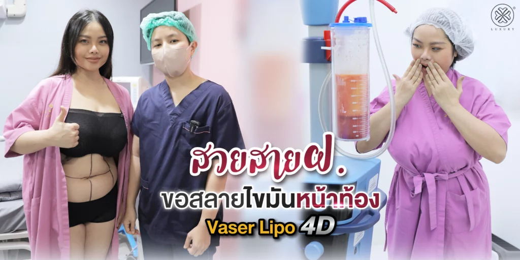 รีวิวดูดไขมัน
