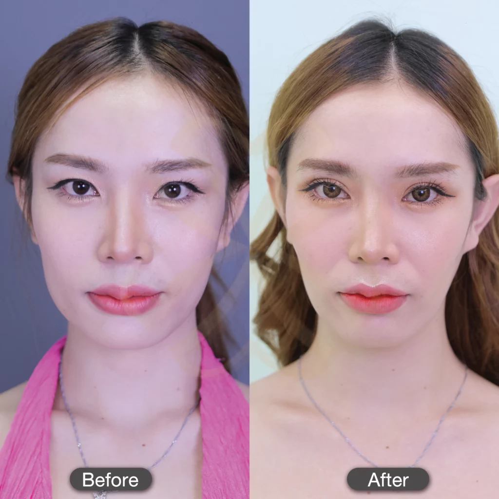 รีวิวตาสองชั้น ทำตาสองชั้นแพงไหม