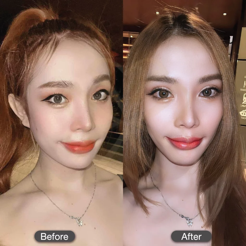 รีวิวตาสองชั้น ทำตาสองชั้นแพงไหม