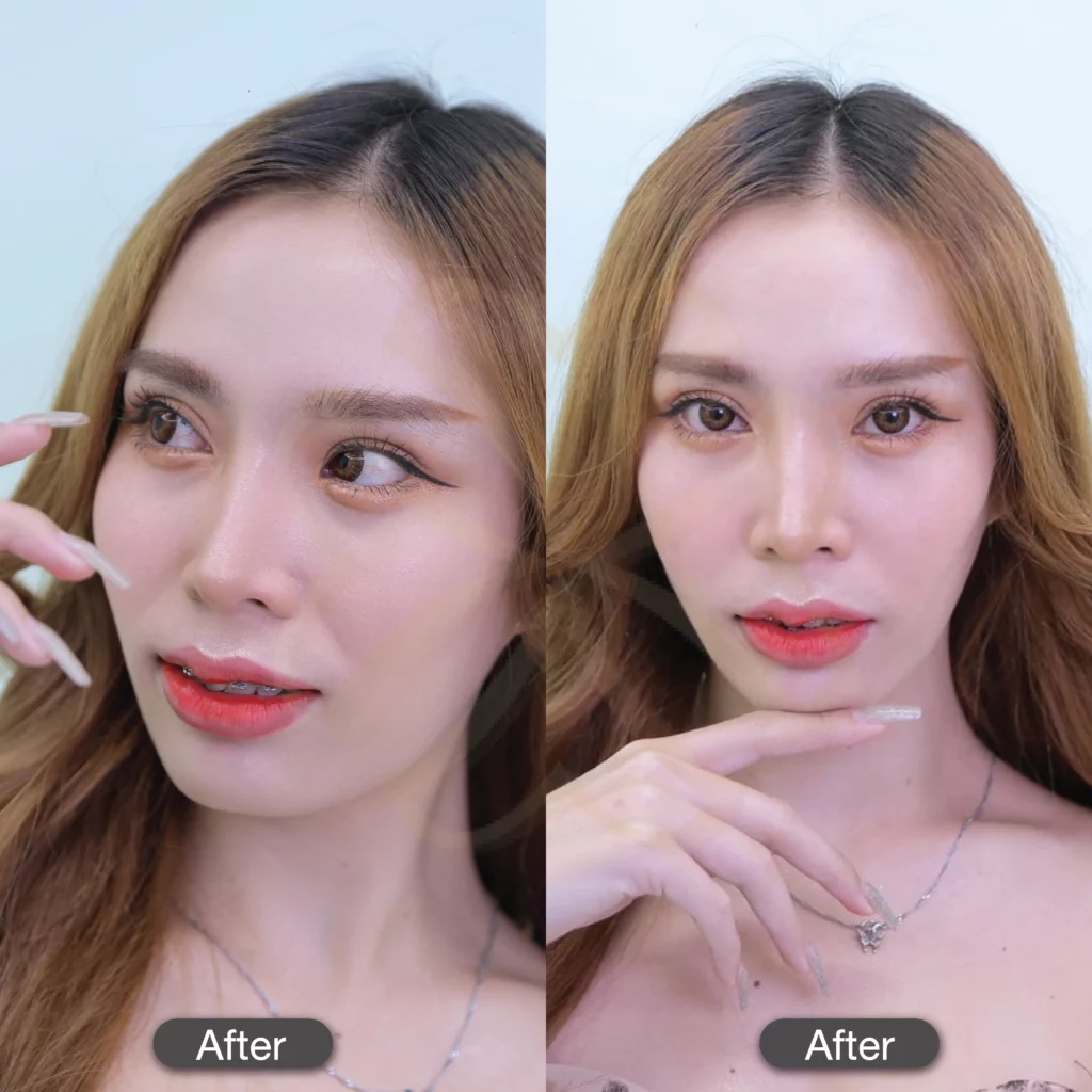 รีวิวตาสองชั้น ทำตาสองชั้นแพงไหม