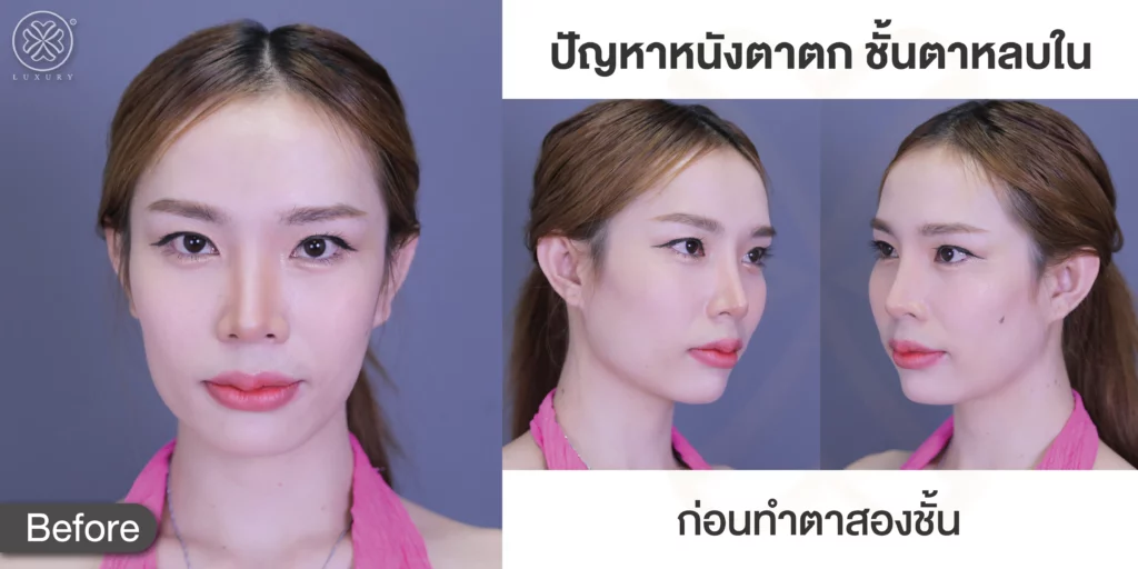 รีวิวตาสองชั้น ทำตาสองชั้นแพงไหม