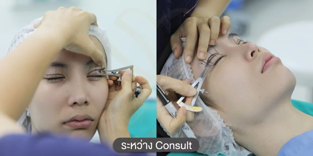 รีวิวตาสองชั้น ทำตาสองชั้นแพงไหม