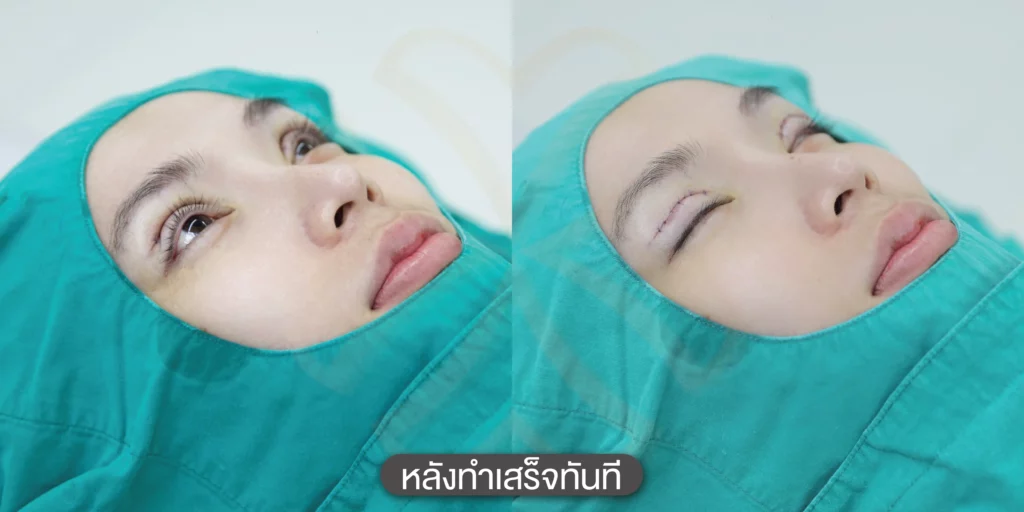 รีวิวตาสองชั้น ทำตาสองชั้นแพงไหม