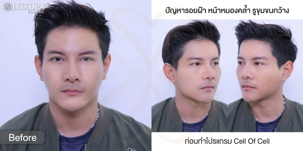 รักษาฝ้า