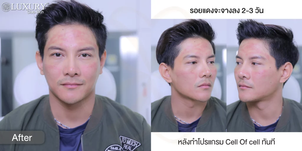 รักษาฝ้า