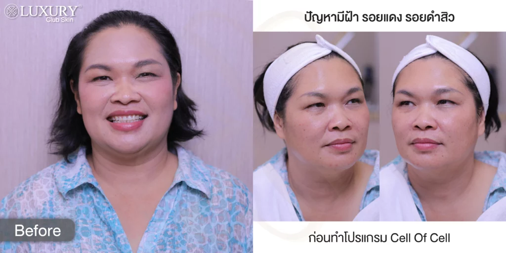 แก้ฝ้า รักษาฝ้า กำจัดฝ้า รีวิวรักษาฝ้า