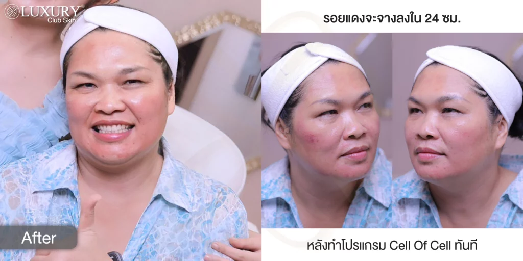 แก้ฝ้า รักษาฝ้า กำจัดฝ้า รีวิวรักษาฝ้า