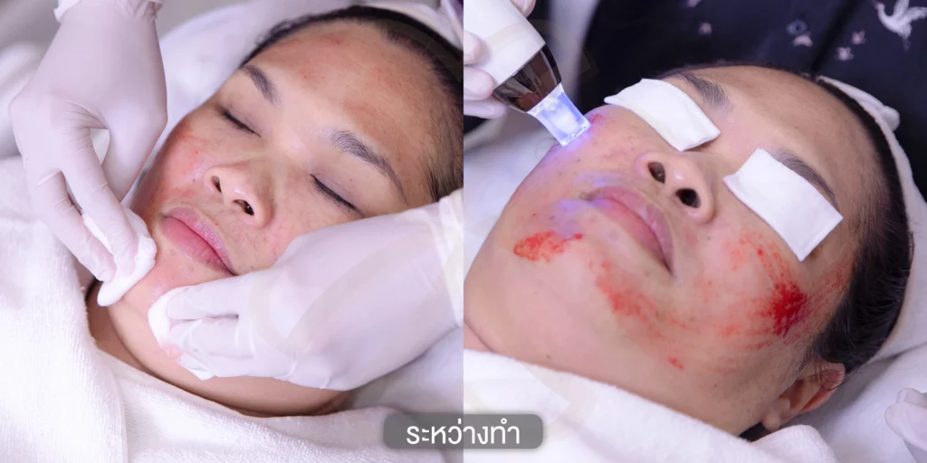 แก้ฝ้า รักษาฝ้า กำจัดฝ้า รีวิวรักษาฝ้า