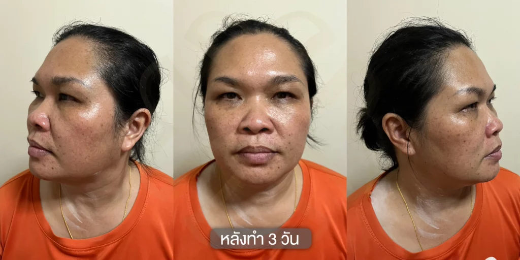 แก้ฝ้า รักษาฝ้า กำจัดฝ้า รีวิวรักษาฝ้า