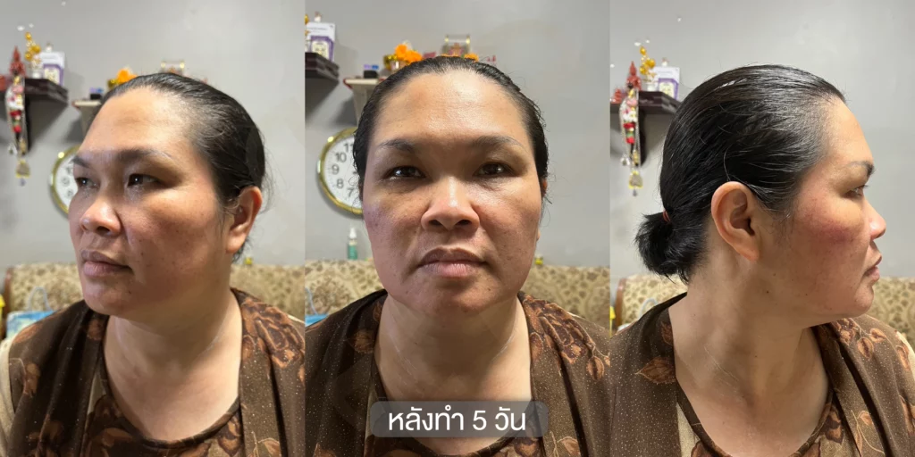 แก้ฝ้า รักษาฝ้า กำจัดฝ้า รีวิวรักษาฝ้า