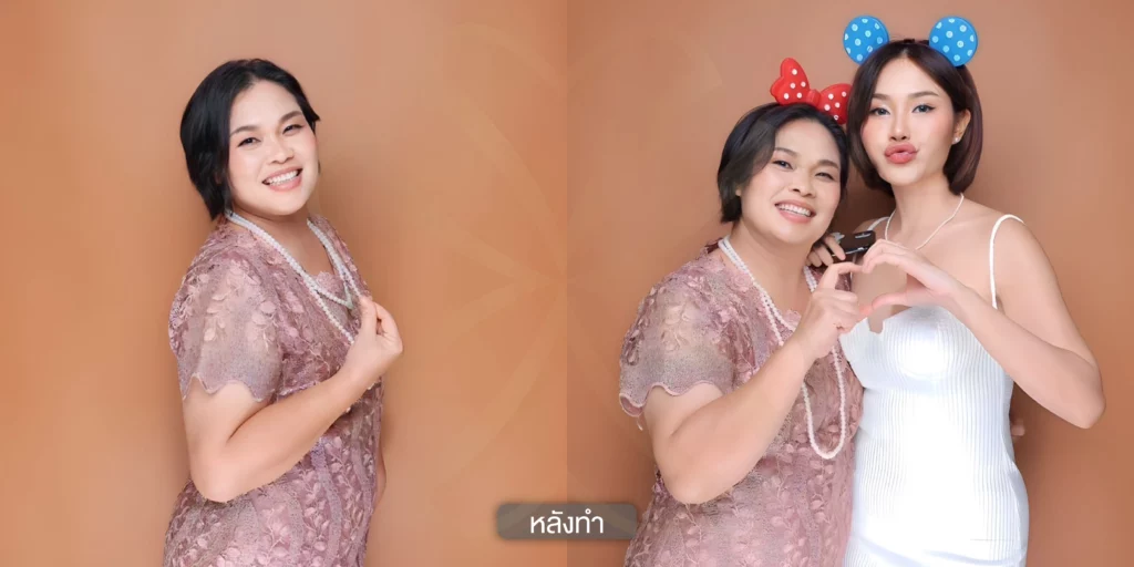 แก้ฝ้า รักษาฝ้า กำจัดฝ้า รีวิวรักษาฝ้า