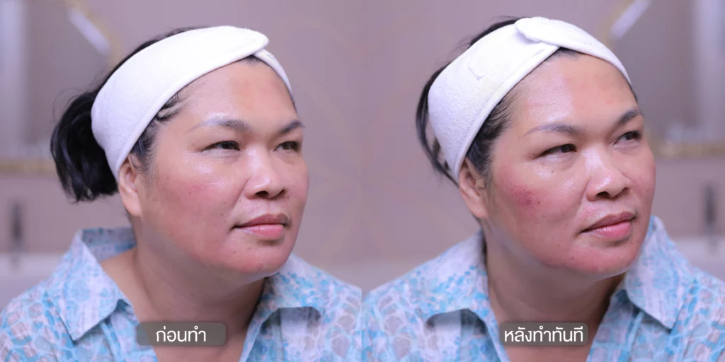 แก้ฝ้า รักษาฝ้า กำจัดฝ้า รีวิวรักษาฝ้า