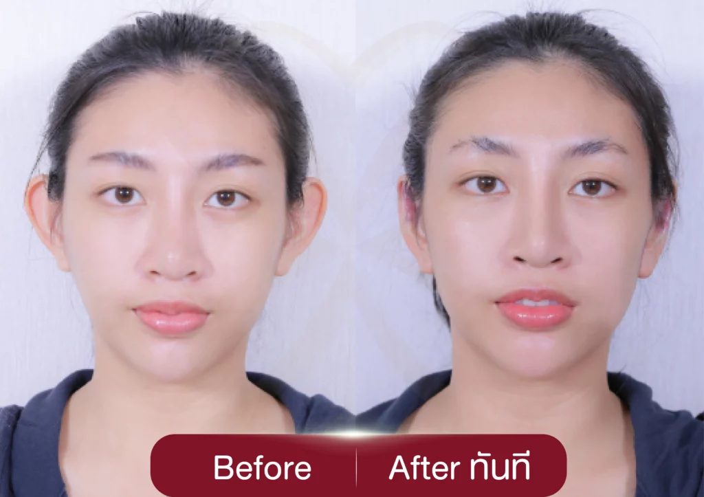 รีวิวหูกาง