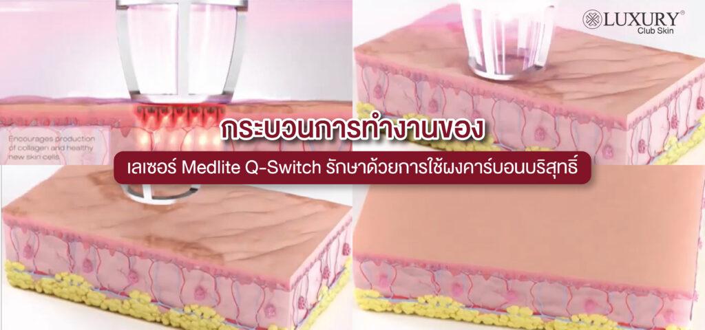 carbon peel laser
