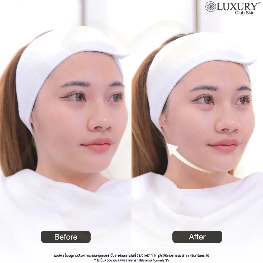 Before After