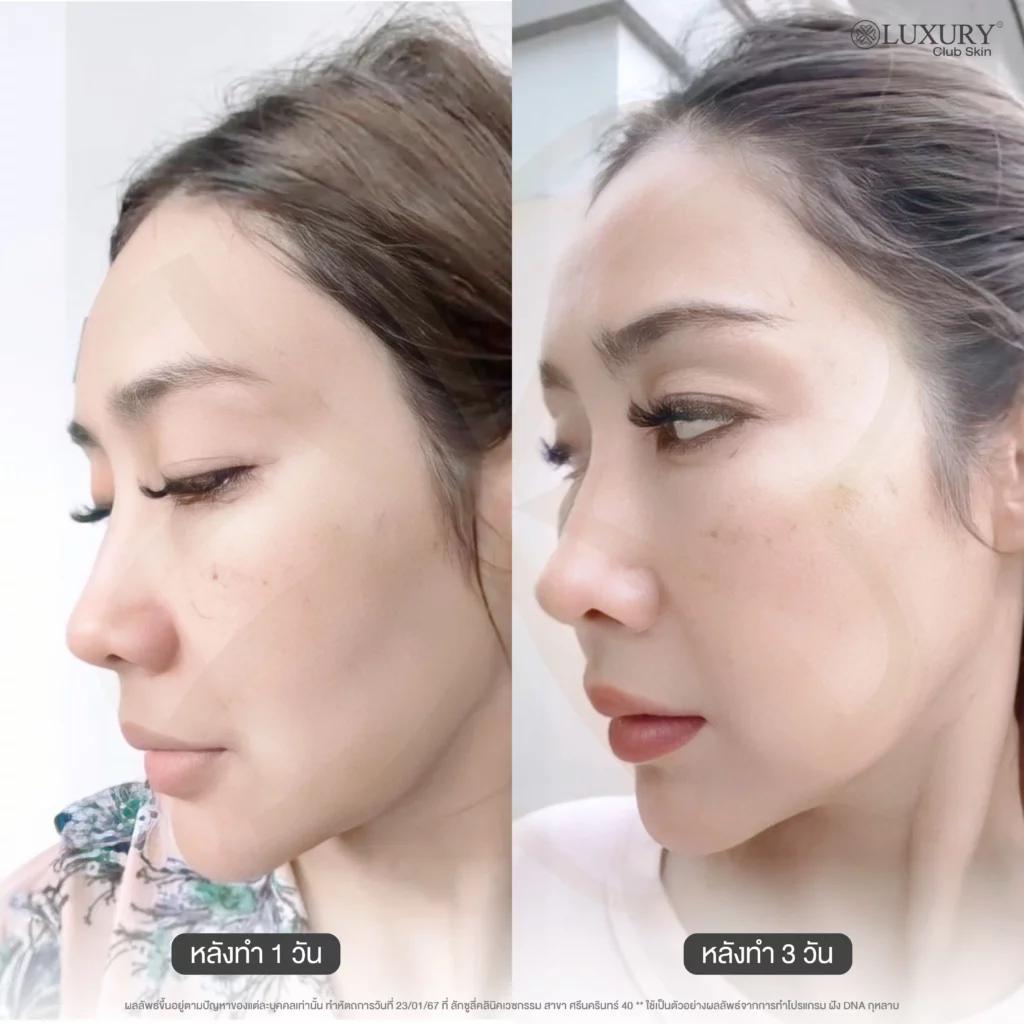 ก่อน-หลัง โปรแกรมฝัง DNA กุหลาบ