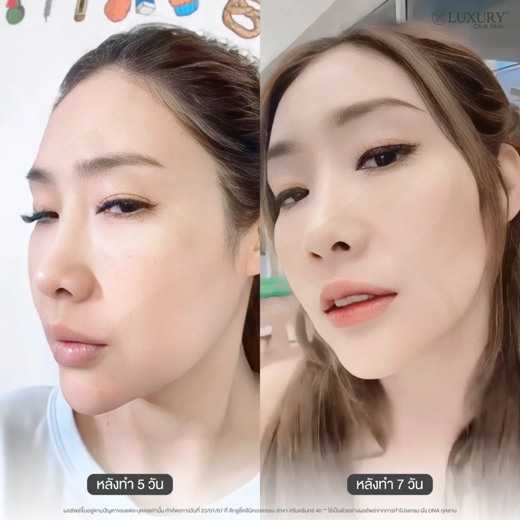 ก่อน-หลัง โปรแกรมฝัง DNA กุหลาบ