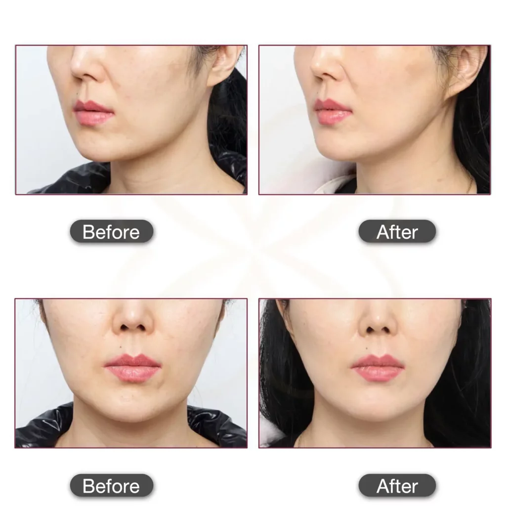 ก่อนและหลังทำ smas contouring