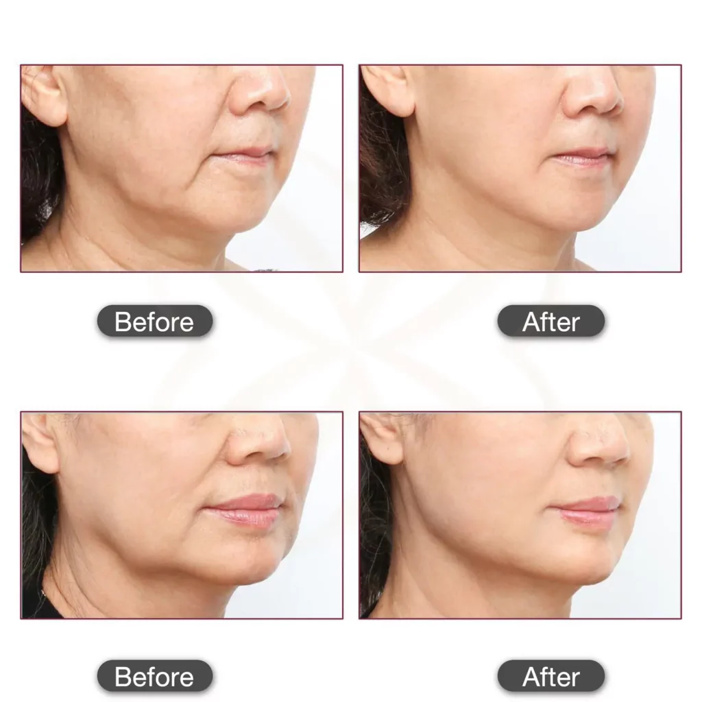 ก่อนและหลังทำ smas contouring