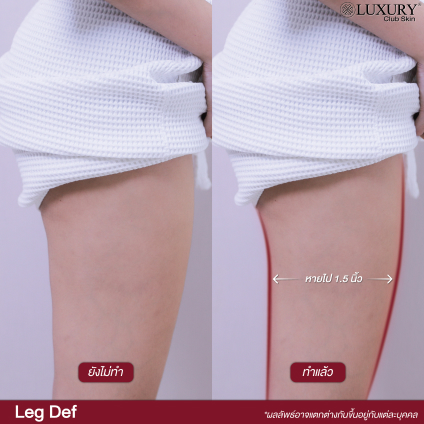 legdef before after