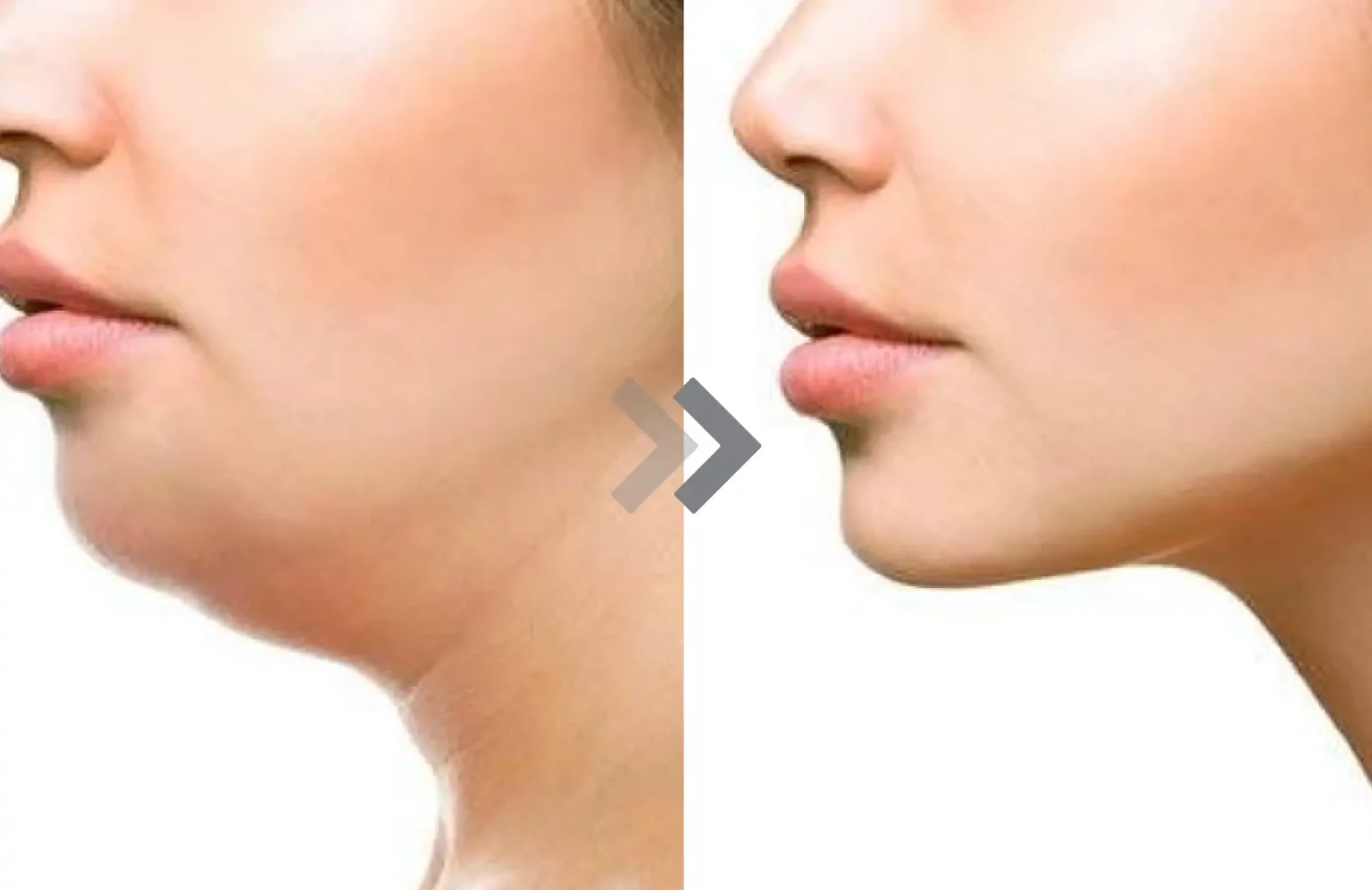 รีวิว Exilis Ultra 360