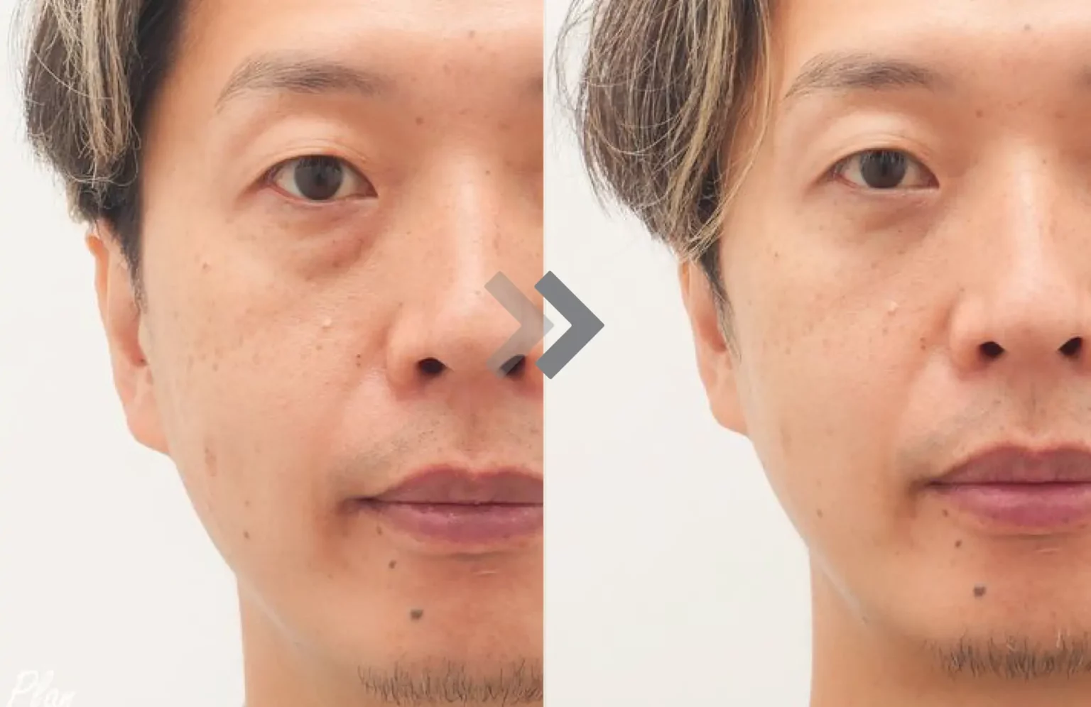 รีวิว Exilis Ultra 360