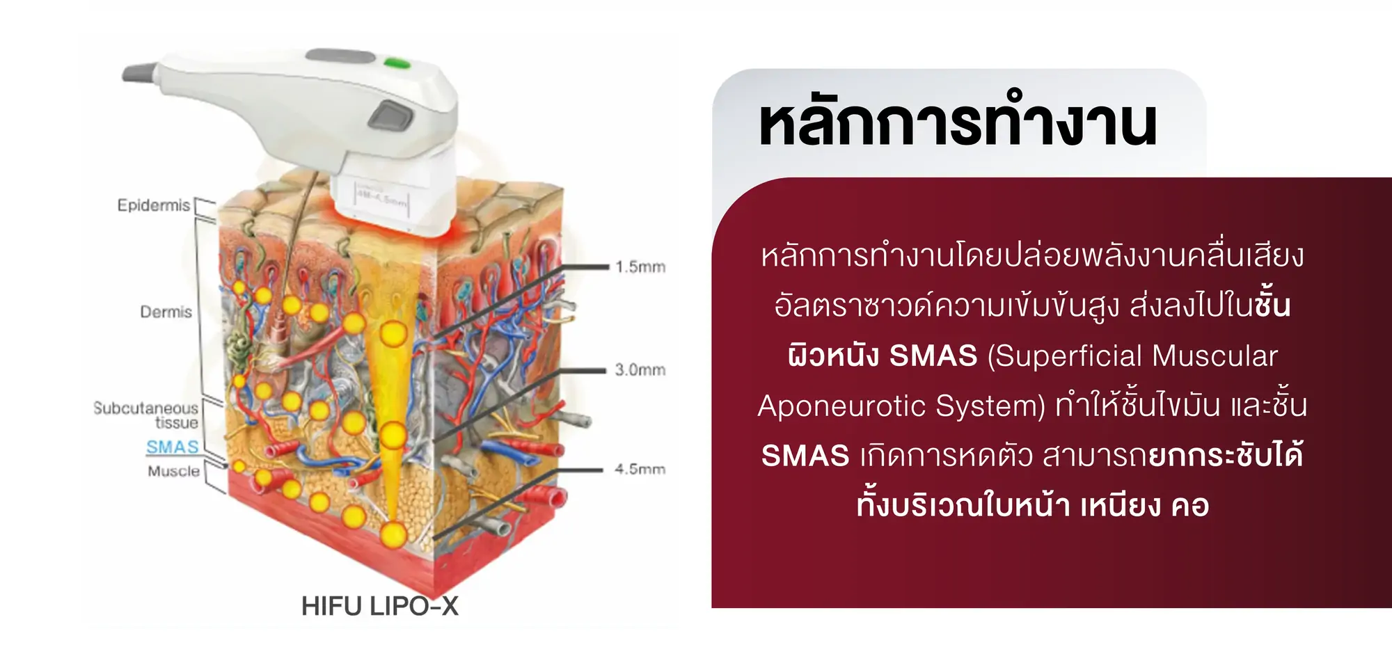 หลักการทำงาน hifu