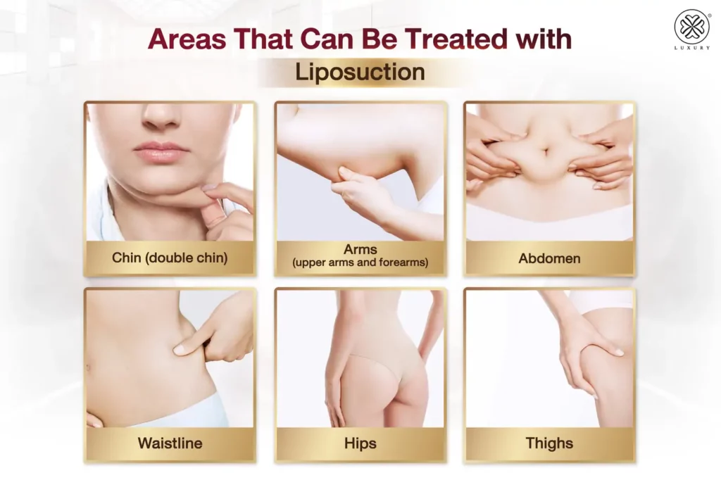 areas that can be treated with liposuction