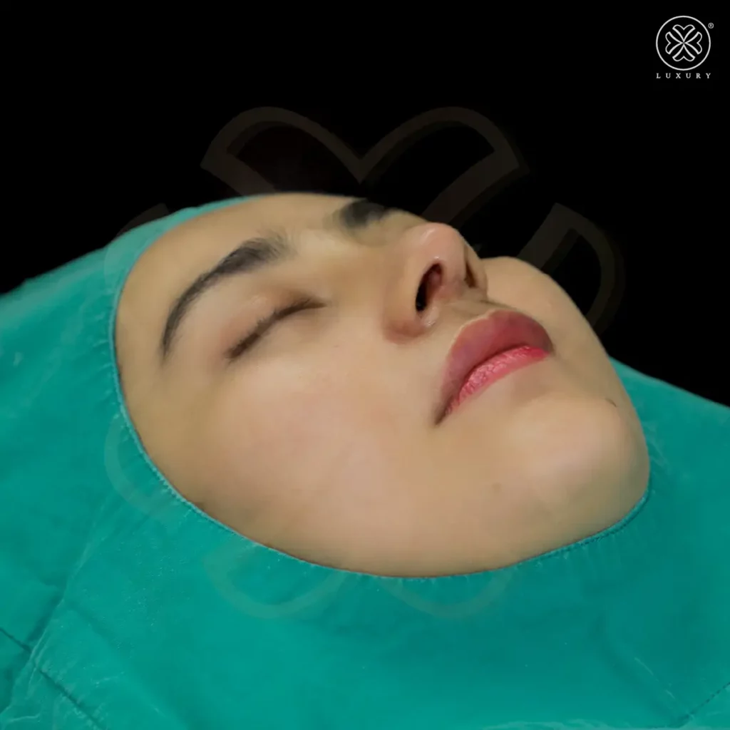 รีวิวเสริมจมูก by ทิลี่