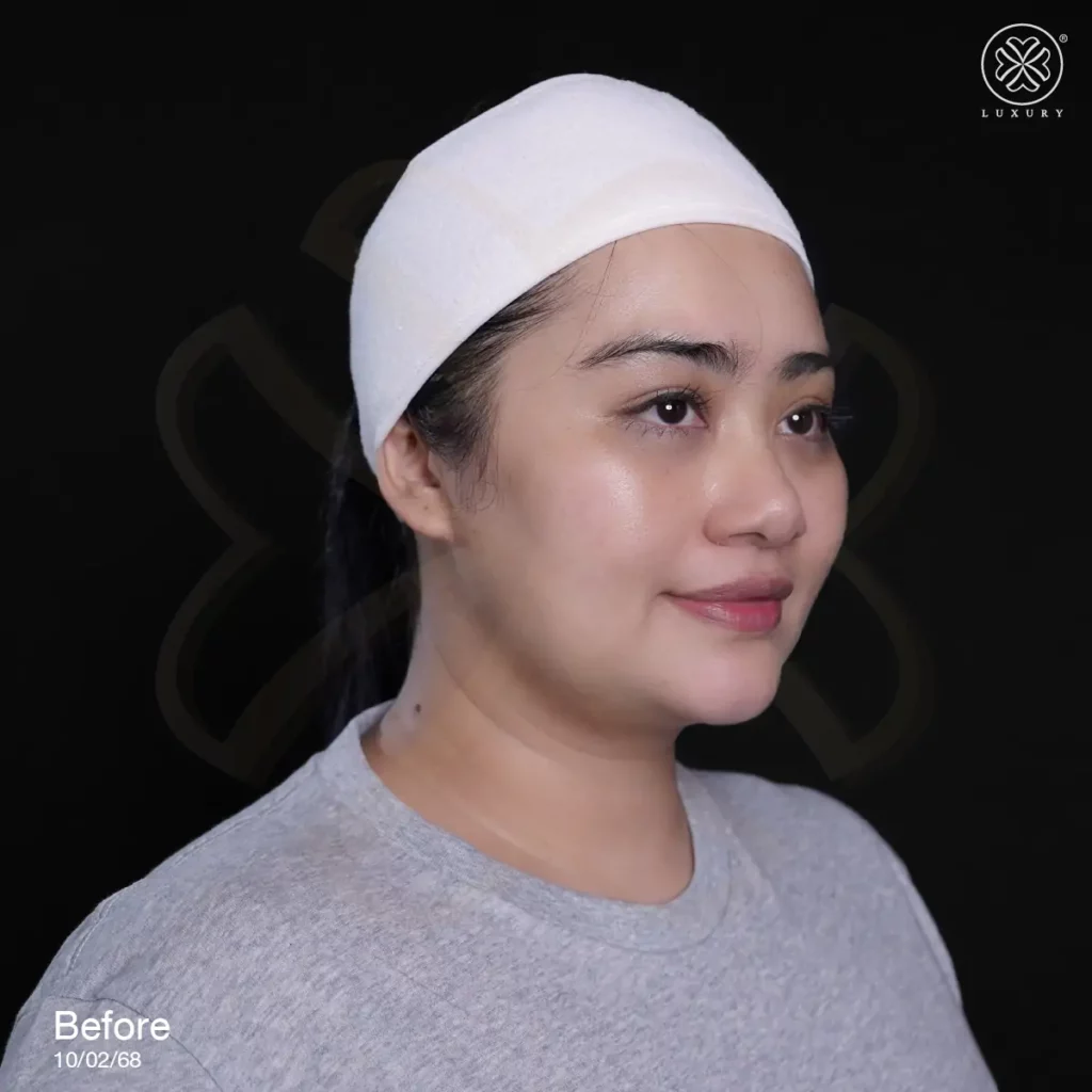 รีวิวเสริมจมูก by ทิลี่
