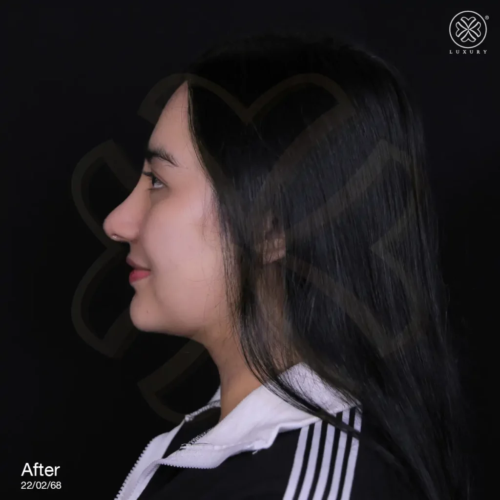 รีวิวเสริมจมูก by ทิลี่