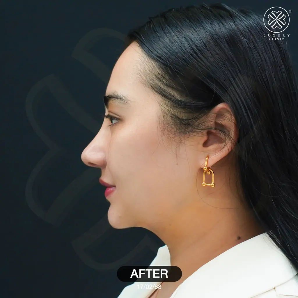 รีวิวเสริมจมูก by ทิลี่