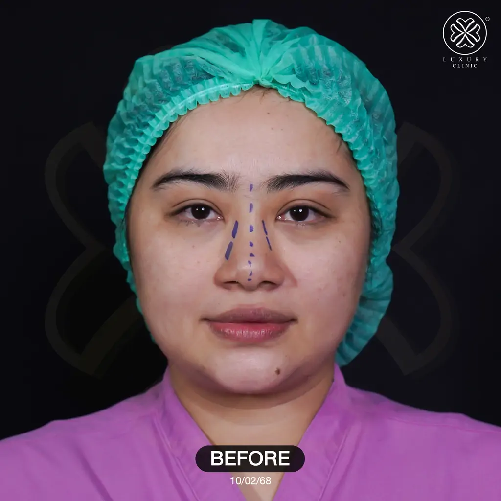 รีวิวเสริมจมูก by ทิลี่