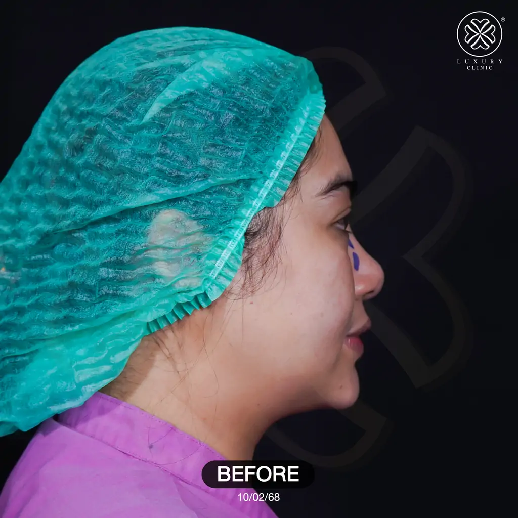 รีวิวเสริมจมูก by ทิลี่