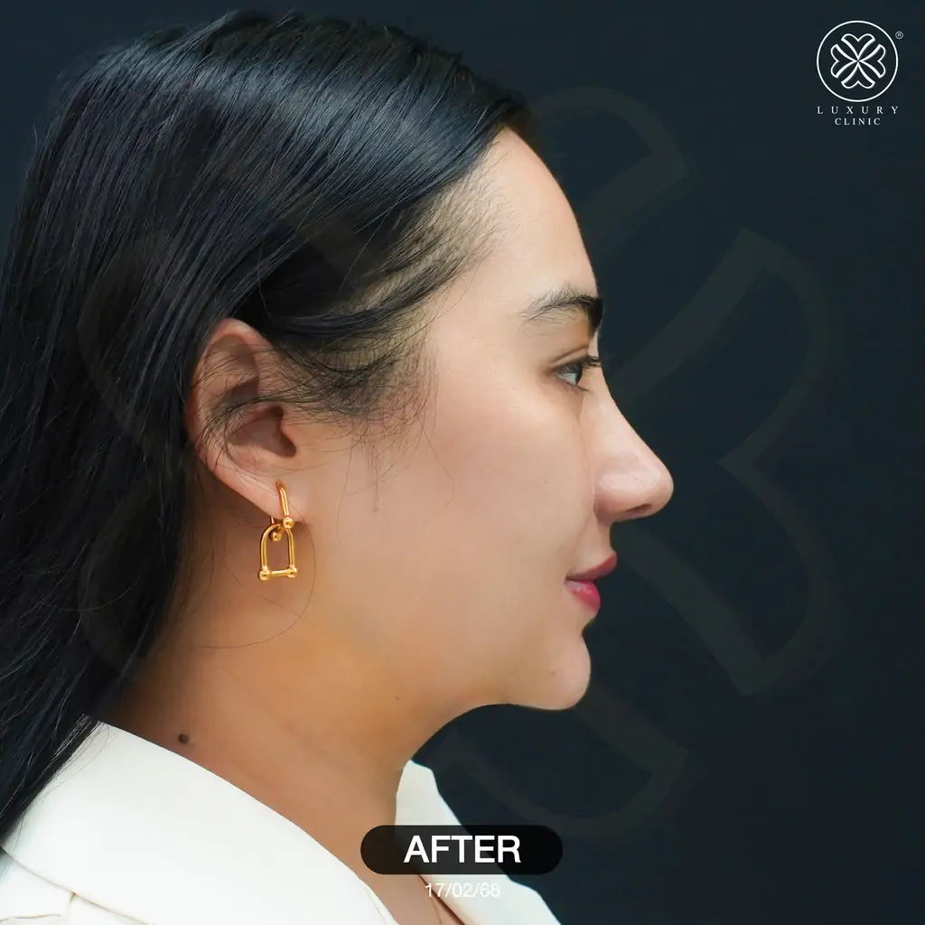 รีวิวเสริมจมูก by ทิลี่