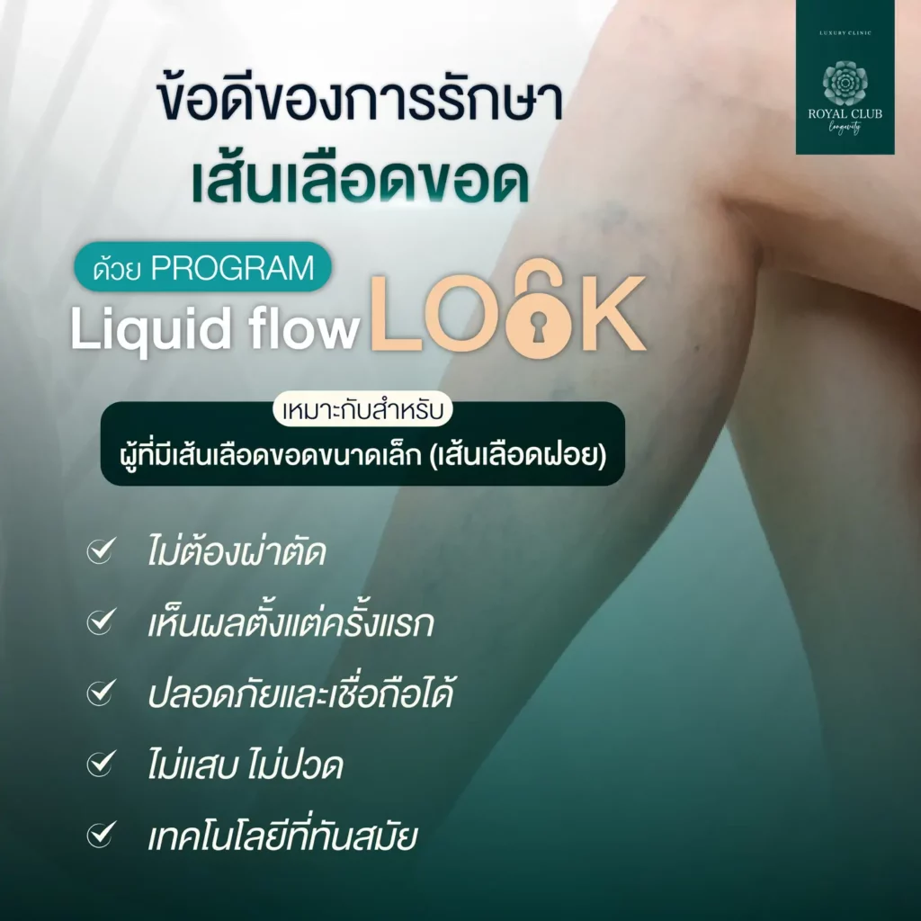 ข้อดีของการรักษาเส้นเลือดขอด