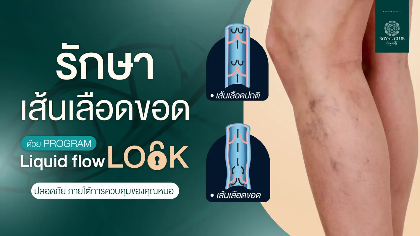 รักษาเส้นเลือดขอด