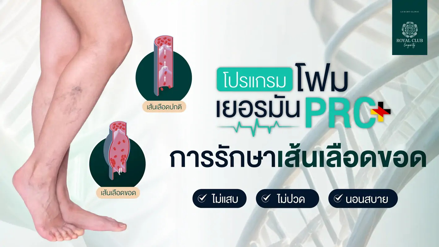 โปรแกรมโฟมเยอรมัน PRC การรักษาเส้นเลือดขอด