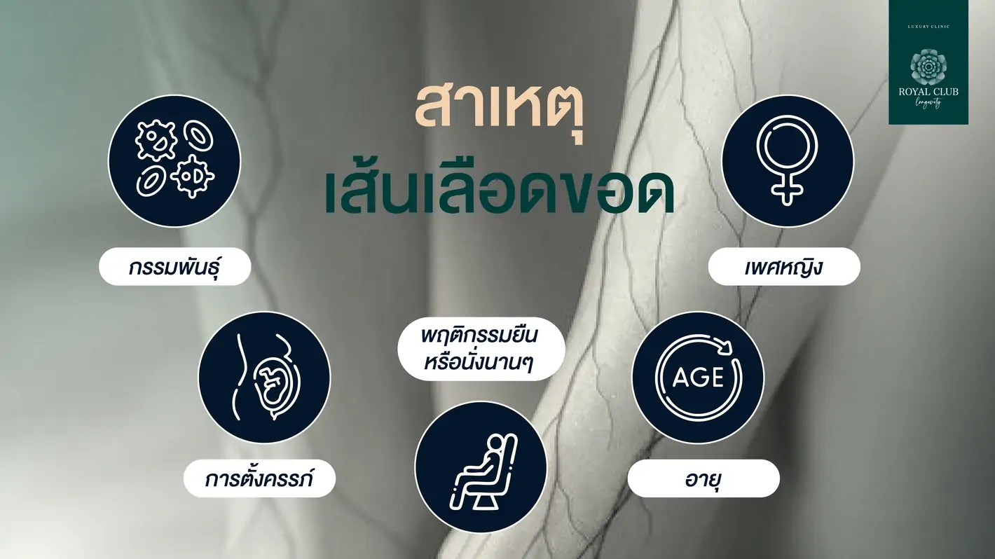สาเหตุของเส้นเลือดขอด
