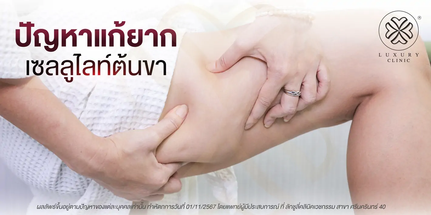 ปํยหาแก้ยาก เซลลูไลท์ต้นขา