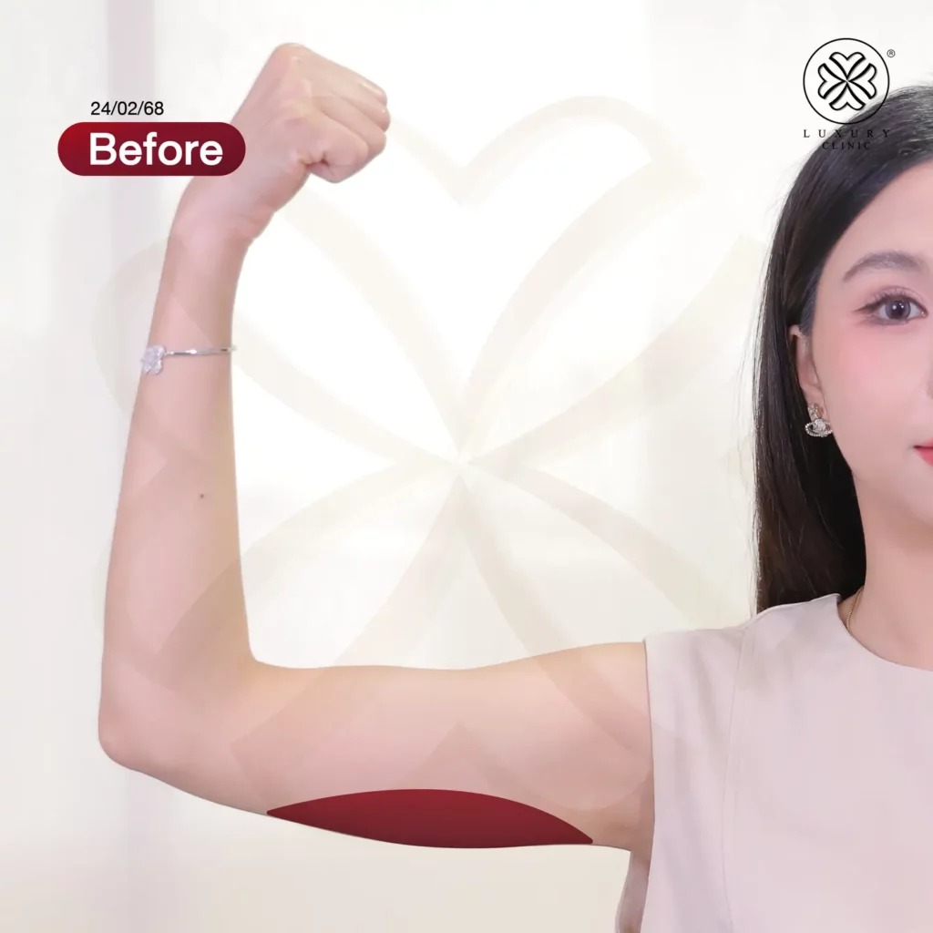 แก้แขนใหญ่ แขนย้วย fix arm