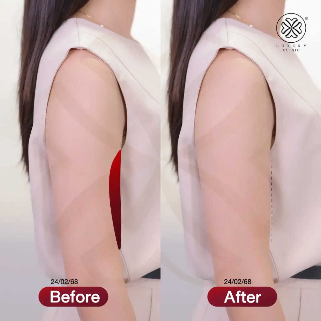 แก้แขนใหญ่ แขนย้วย fix arm