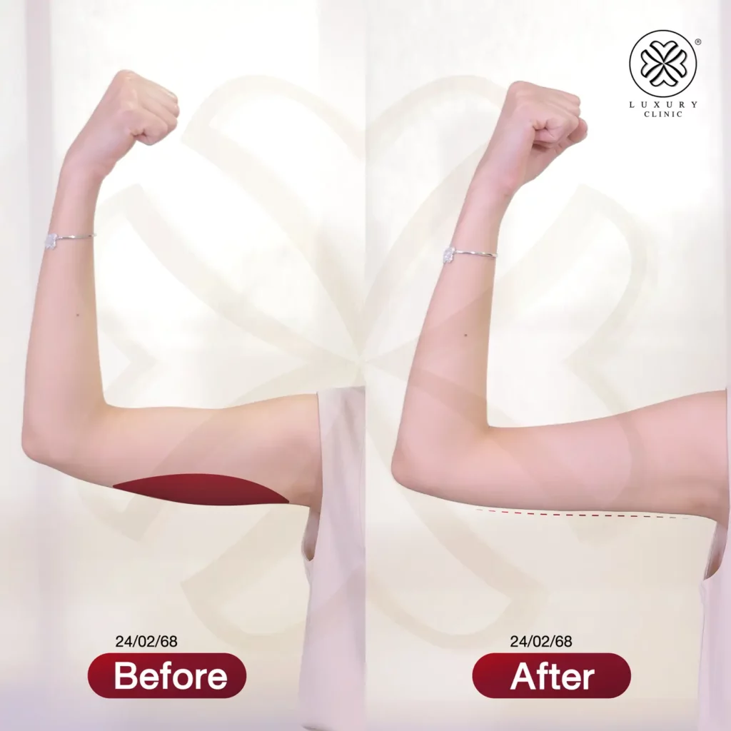 แก้แขนใหญ่ แขนย้วย fix arm
