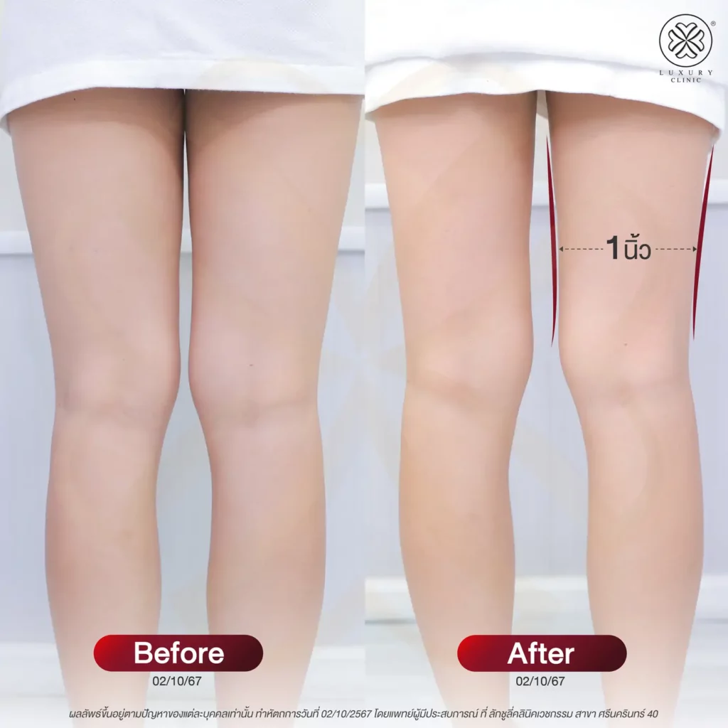 หลังทำ legdef