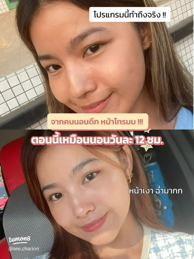 บอกต่อหัตถการหน้าฉ่ำน้ำ