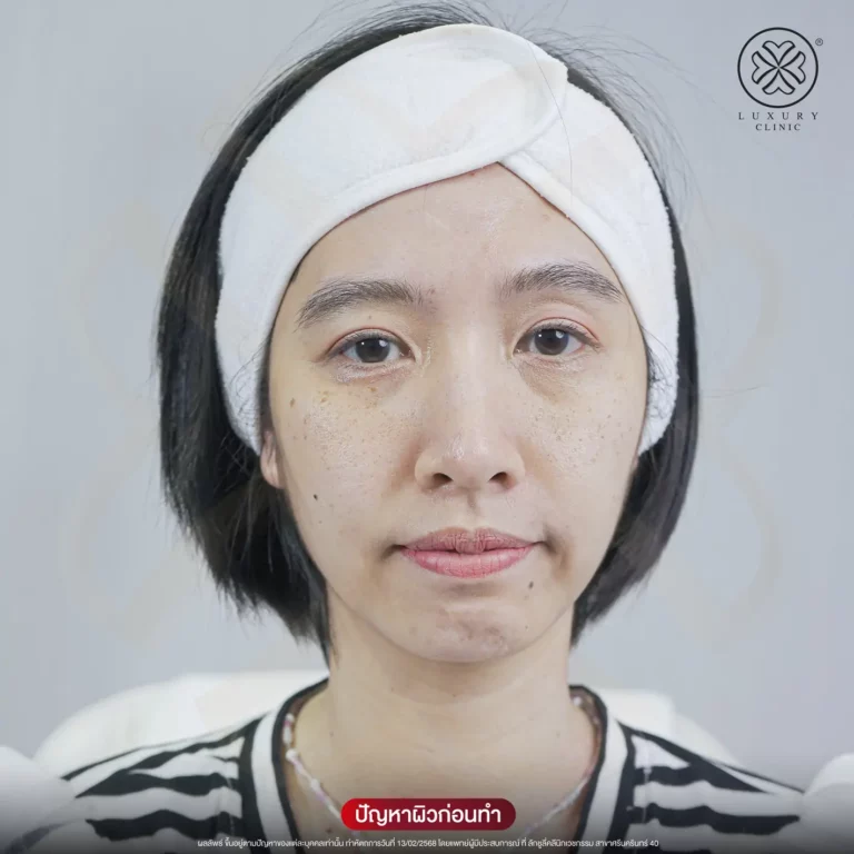 รักษาฝ้าหนา ปัญหาก่อนทำ