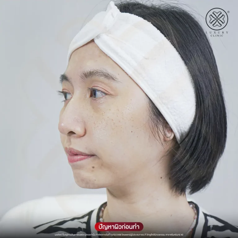 รักษาฝ้าหนา ปัญหาก่อนทำ